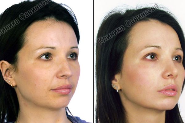 rinoplastic-1-175FFE0D9-3B87-CAE8-F44A-5FFBA5CB00A8.jpg