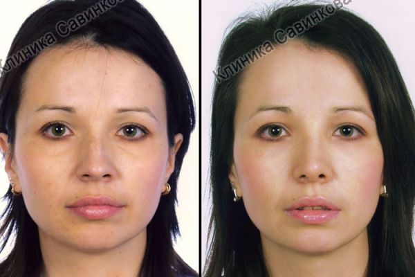 rinoplastic-1-26E69E7B0-E5CC-528A-B0A8-9479EDC6628A.jpg