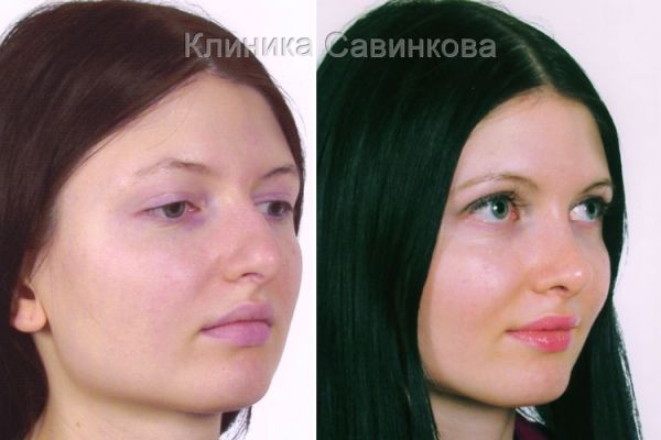 rinoplastic-10-1DD0A7F68-75D0-6493-A8DC-03EE60E4476D.jpg