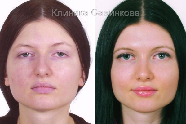 rinoplastic-10-2687A5487-3EC4-28D9-D368-C5F897312552.jpg