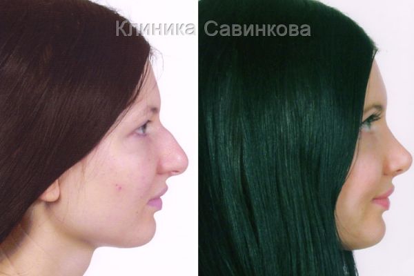 rinoplastic-103A5907AB-C6FD-4F5B-29BF-0571AB496C4F.jpg