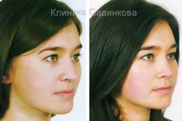 rinoplastic-11-17F3574F0-1AFF-A0D0-E869-57C2F95E46F4.jpg