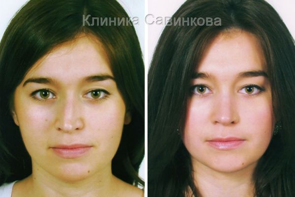 rinoplastic-11-2C8986AE8-962E-23FD-8AC1-392B7BF696EE.jpg