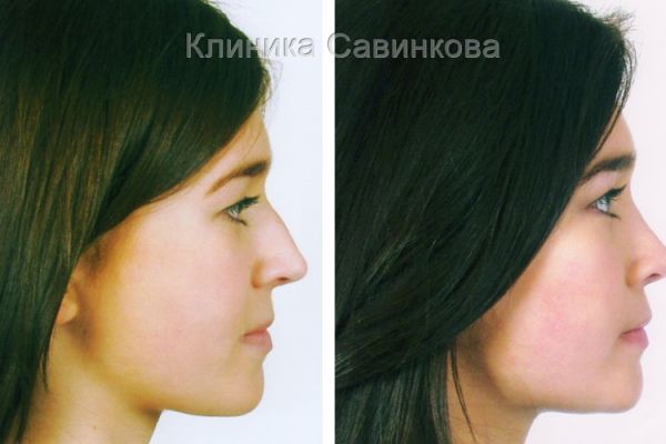 rinoplastic-11DB5844E5-155A-9BE3-EE17-3642A2C28448.jpg