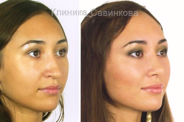 rinoplastic-12-1BA86048B-E0E8-8AF0-463B-5E27C42B7188.jpg