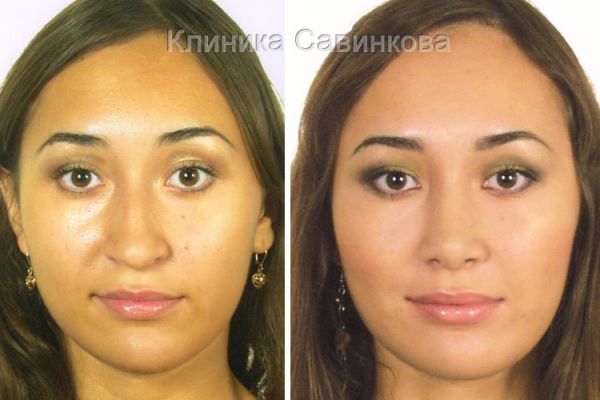 rinoplastic-12-25F82AC4D-3BE5-5D07-7BB4-166C7A2A270D.jpg