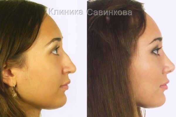 rinoplastic-12767CAC5B-42BD-F1ED-B23F-A4A7D9492A5D.jpg
