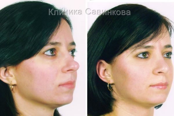rinoplastic-13-1506733EE-DC77-BA48-C827-D034617837F3.jpg