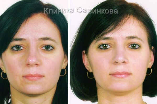 rinoplastic-13-296336E2F-9A21-A3B0-58C2-B81184FD106E.jpg