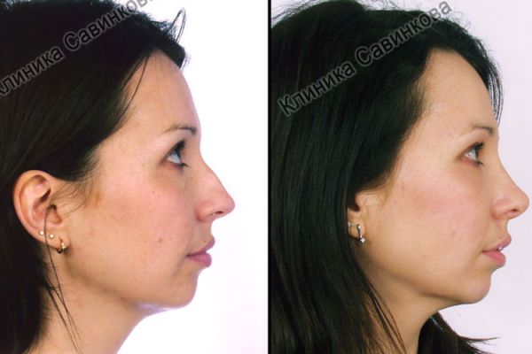 rinoplastic-1399E75F9-B6FD-E5A8-280A-1CF3BB4C2ED2.jpg
