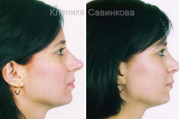 rinoplastic-13C3B24583-E8DB-6544-5692-C5D716CEE2C4.jpg