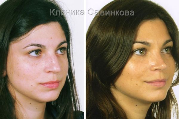 rinoplastic-14-18F1C0A87-A00D-2744-89A0-245857E06113.jpg