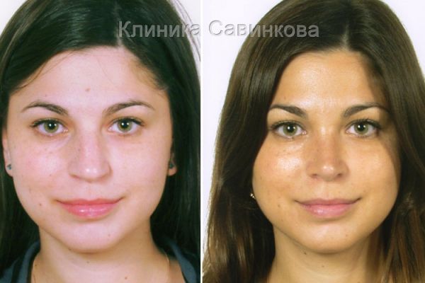 rinoplastic-14-21EAA056B-070C-0340-2296-C5FD3120C578.jpg
