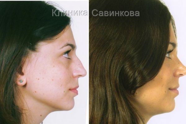 rinoplastic-14BA1F4423-694A-6018-E1B3-FA8D938188E5.jpg