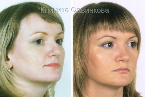rinoplastic-15-18FA59B52-B604-5514-F041-933D27A3DADF.jpg