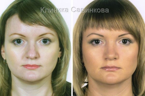 rinoplastic-15-2F1087255-77F8-460F-4DB4-C36FBAE24CE1.jpg