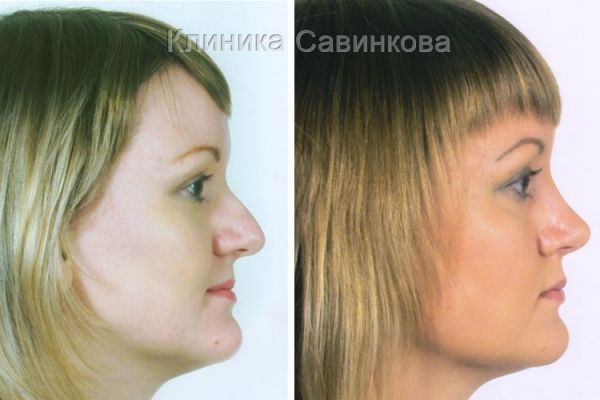 rinoplastic-1537E6F0AA-C886-8651-343B-AD3211807FD6.jpg
