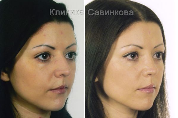 rinoplastic-16-10D596EA8-8A5D-2A3F-7385-FC035261969F.jpg
