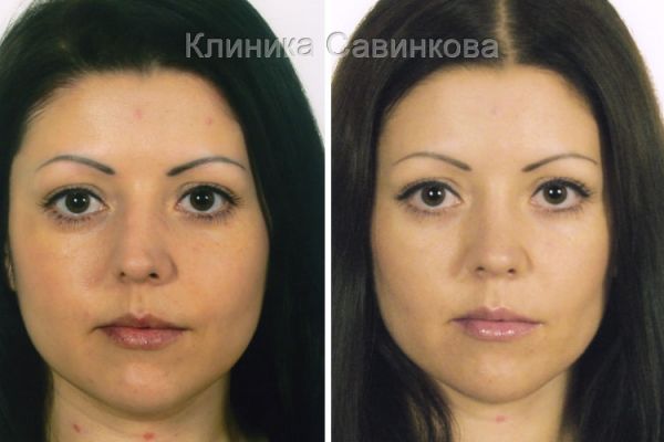 rinoplastic-16-2CA4F122C-5BB9-25CA-7D4D-7F0B58D42CD0.jpg
