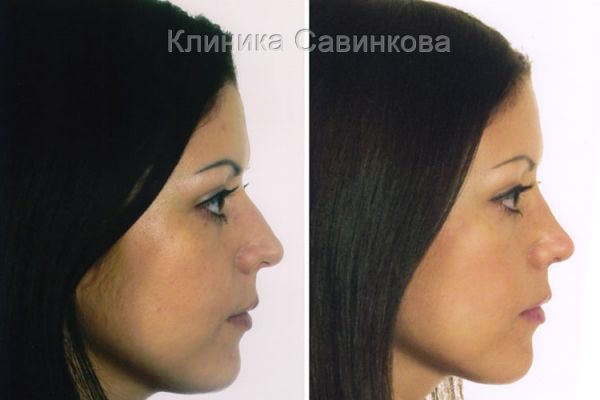 rinoplastic-16FE3280B3-4718-98B2-F074-77C05590B76C.jpg