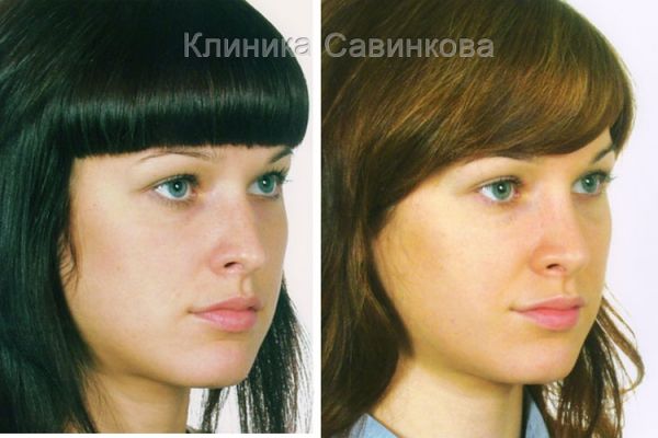 rinoplastic-17-1BE0070AA-CBDD-7A6C-EB1A-184AD3A9BB23.jpg