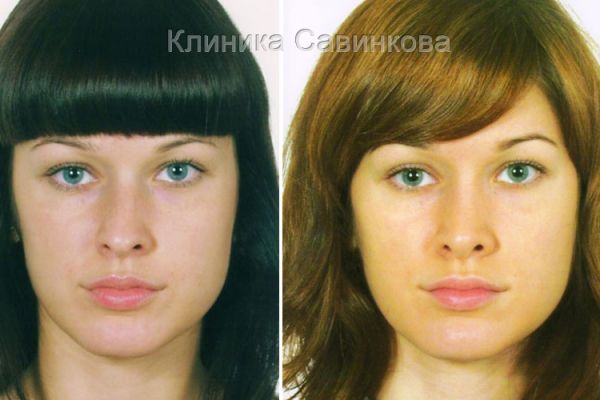 rinoplastic-17-2B00840A9-5B48-3D7C-FEC1-59F60BBDEDF9.jpg