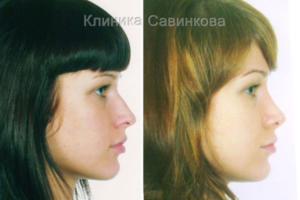 rinoplastic-171137721F-0ED9-43FD-F1A0-402B172F9009.jpg