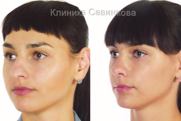 rinoplastic-18-14D766640-6346-0D06-937F-6930CC87F884.jpg