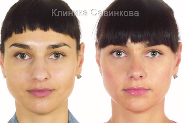 rinoplastic-18-255F1A26E-5DCF-ACCC-96CB-0E249F82D18E.jpg