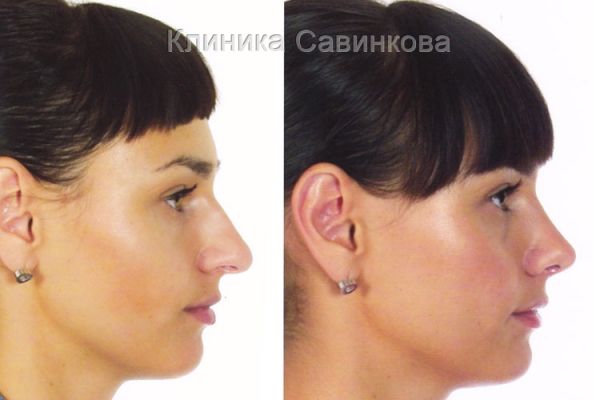rinoplastic-1800FCFD37-4218-8741-DC88-810BEB24D278.jpg