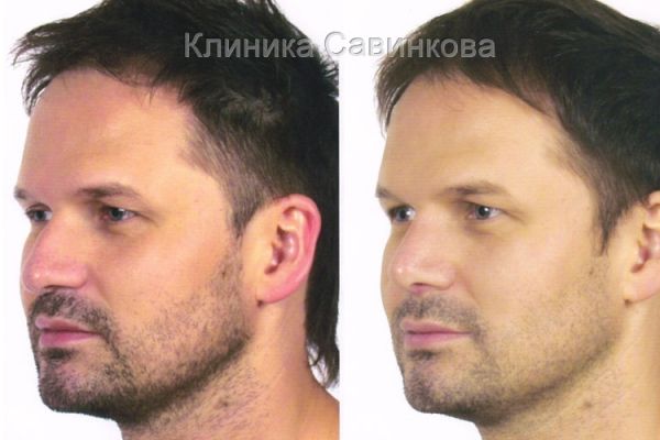 rinoplastic-19-1E405813E-40B3-C502-224E-A100FFA7DFA2.jpg
