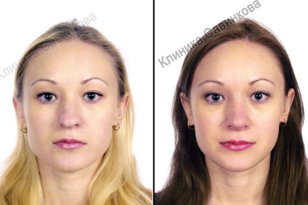 rinoplastic-2-1BE5CA35D-1065-A19D-1D01-B17EF7EEC9DB.jpg