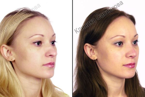 rinoplastic-2-26EC1B9FA-7AB7-7FEE-4516-B97CEEEE15E4.jpg