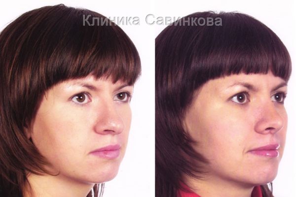 rinoplastic-20-1AF048453-E0D6-EA7F-36E4-A09B4A4E6C42.jpg