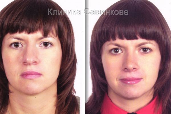 rinoplastic-20-2AE62472E-D298-B279-64DB-B2FAB28CEEEC.jpg