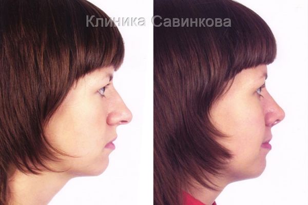 rinoplastic-2064EA4EC0-5986-FEDA-3B2B-AFD2004AA15E.jpg