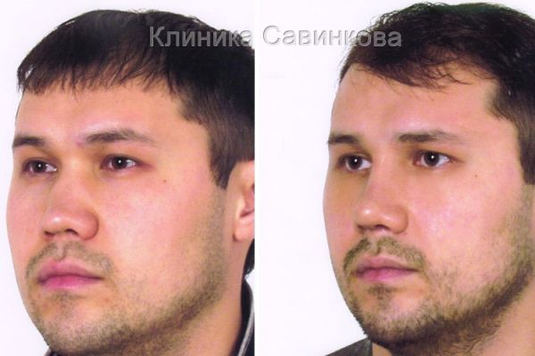 rinoplastic-21-1A2834662-0887-A641-DAD9-51390C449066.jpg