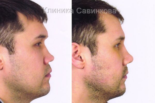 rinoplastic-2124306D5C-6CF6-D203-5BCB-AD08F1962536.jpg