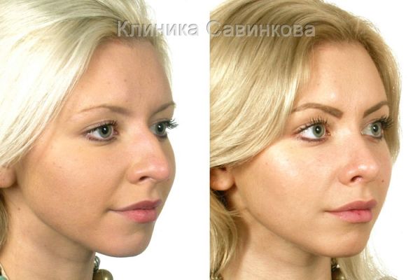 rinoplastic-22-16FCE5002-4586-9B58-969B-9AEC31503F89.jpg