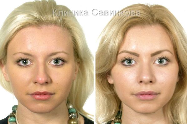 rinoplastic-22-2B29BFDF7-3A80-7462-8BAD-B8D8852BC5EF.jpg