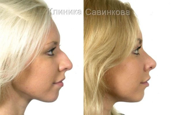 rinoplastic-2234404726-64AE-93F6-B463-5E1B7EF39C55.jpg