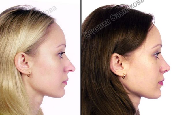 rinoplastic-2515BA470-72EC-EE24-0F63-5C5D7B6C77A0.jpg