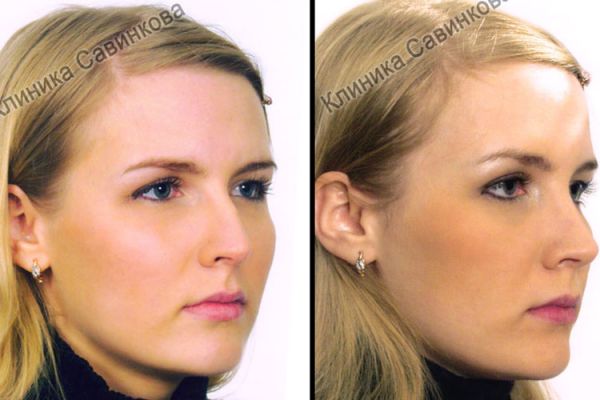 rinoplastic-3-120FB3E5F-DDF4-EFD6-8246-5B7F6EE56CB2.jpg