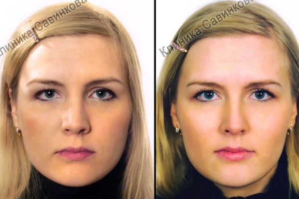 rinoplastic-3-22D3907CA-12E6-9B1D-7B92-DD055A40C12C.jpg
