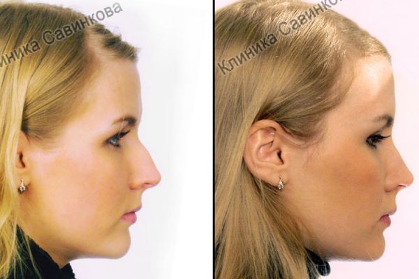 rinoplastic-33493A597-76CE-949F-361E-C8E52C5552DA.jpg