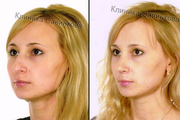 rinoplastic-4-16297B8E4-B9B4-A184-8380-84213C03B440.jpg