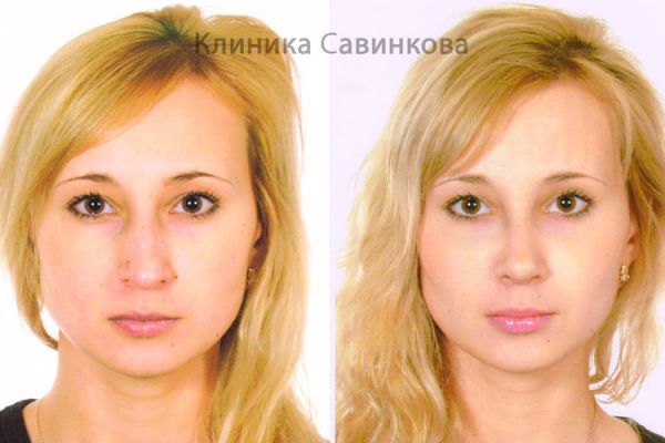 rinoplastic-4-2CB402808-10BA-631E-3897-937299F7B102.jpg