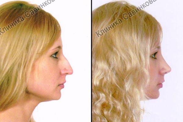 rinoplastic-406E200D0-0D32-A267-60C1-9D9EDB2F0CE0.jpg
