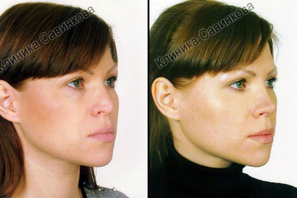 rinoplastic-5-184AF5F2C-DBEE-6578-BDF4-602E6D62B927.jpg