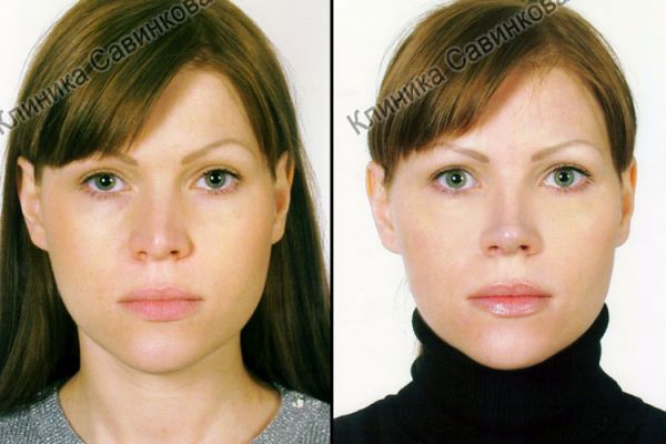 rinoplastic-5-2C7B1CB05-FCF5-8B9F-1A54-C60EF6162D82.jpg